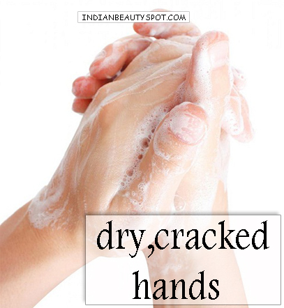 Home remedies for Dry Cracked Hands