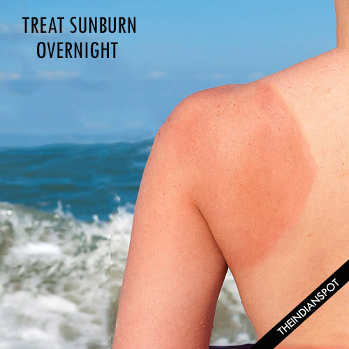 Home remedies to Treat sunburn overnight