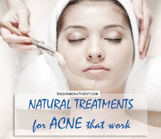 5 Best Natural Treatments for Acne That Work | THE INDIAN SPOT