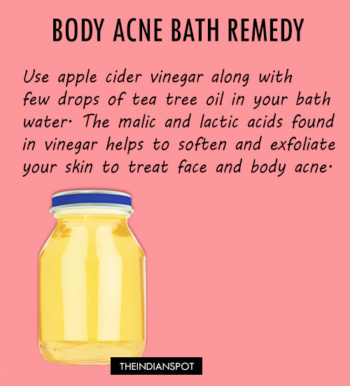 Natural treatments to get rid of body or back acne