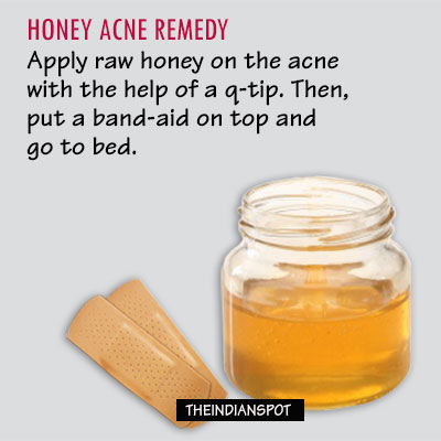 Honey for acne and blackheads