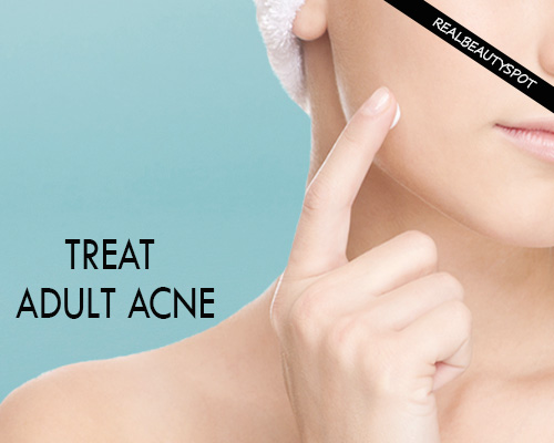 Fighting Out Adult Acne - causes and remedies