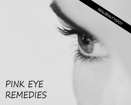 Easy Home Remedies For Conjunctivitis / Pink eye