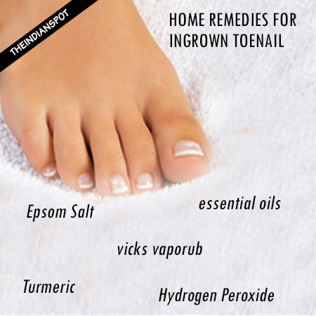 5 Home Remedies For Ingrown Toenail That Really Work