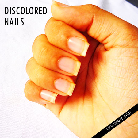 NATURAL REMEDIES TO TREAT NAIL DISCOLORATION
