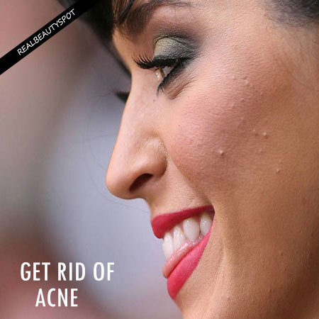 POSSIBLE REASONS YOU CANT GET RID OF YOUR ACNE