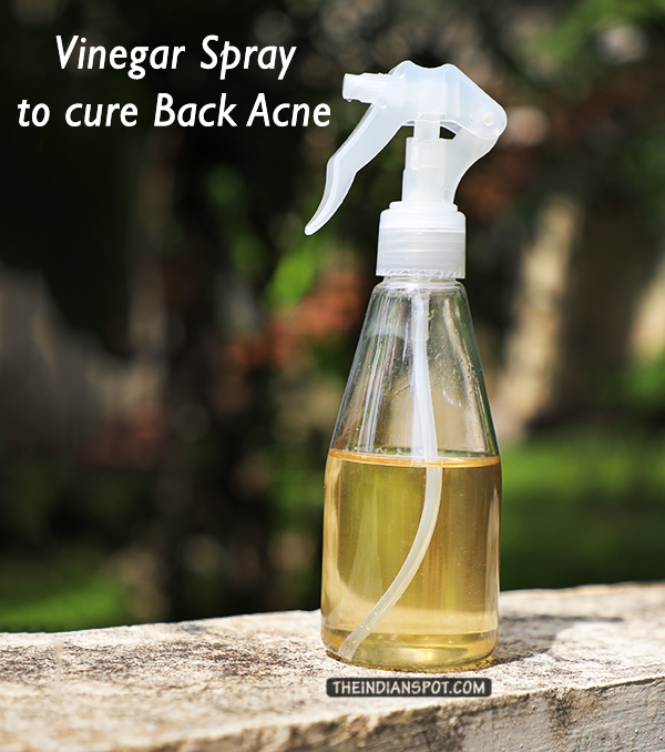 Apple cider vinegar to cure Back Acne