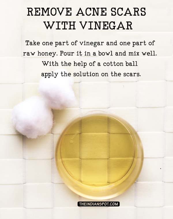 How to Remove Acne Scars Quickly with Apple Cider Vinegar