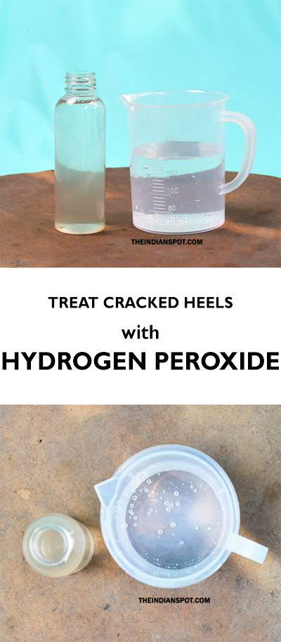 Hydrogen Peroxide For Treating Cracked Heels